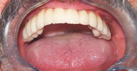 «Dientes en el día». Implantes dentales con carga inmediata.
